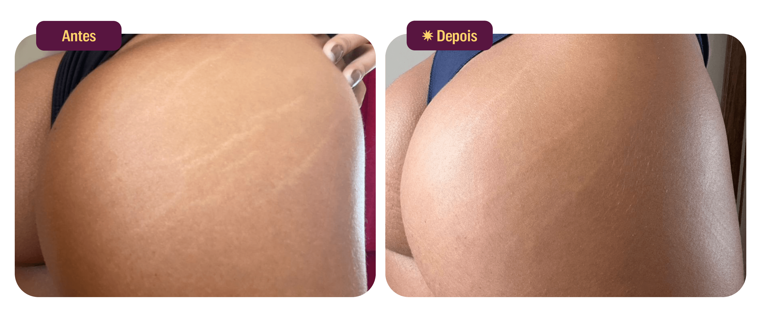 files/Antes-Depois-Uso-Antiestrias-Desk.png