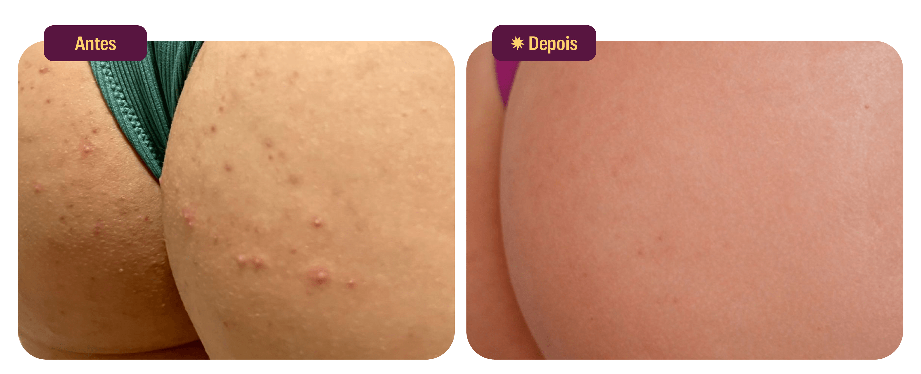 files/Antes-Depois-Uso-Bumbum-Cream-2-Desk.png