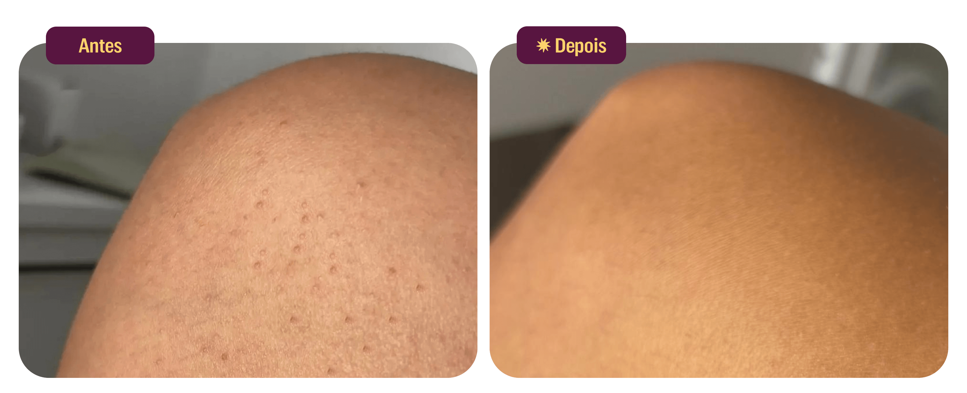 files/Antes-Depois-Uso-Bumbum-Cream-Suave-2-Desk.png